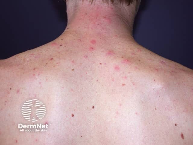 image showing back acne on a man