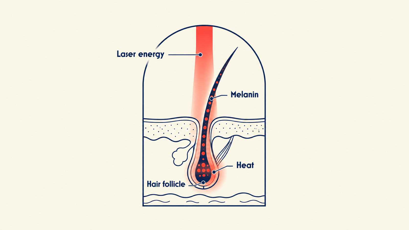 Diagram showing laser energy targeting pigment in a hair follicle.