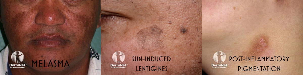 three examples of hyperpigmentation in men