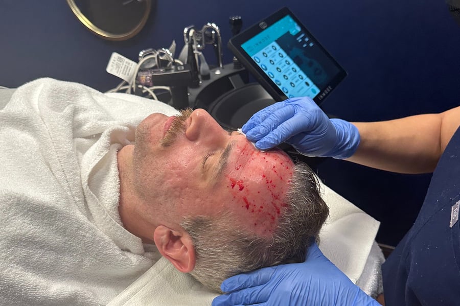 actual Morpheus8 treatment showing microwounds and bleeding