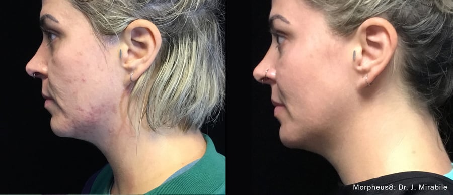 Before and after results Morpheus8 treatment on acne scarring