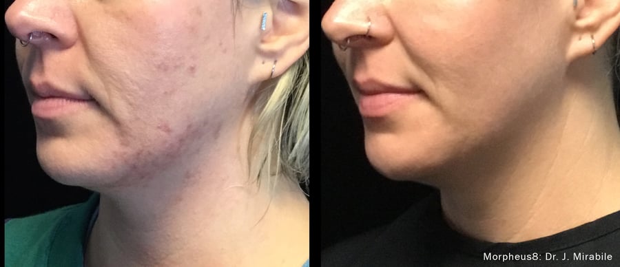 Morpheus8 results on acne scarring