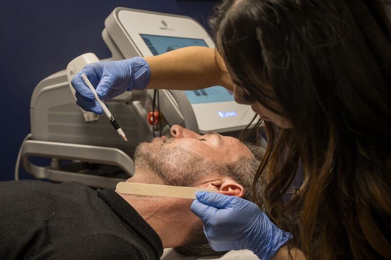 marking the face for laser hair removal