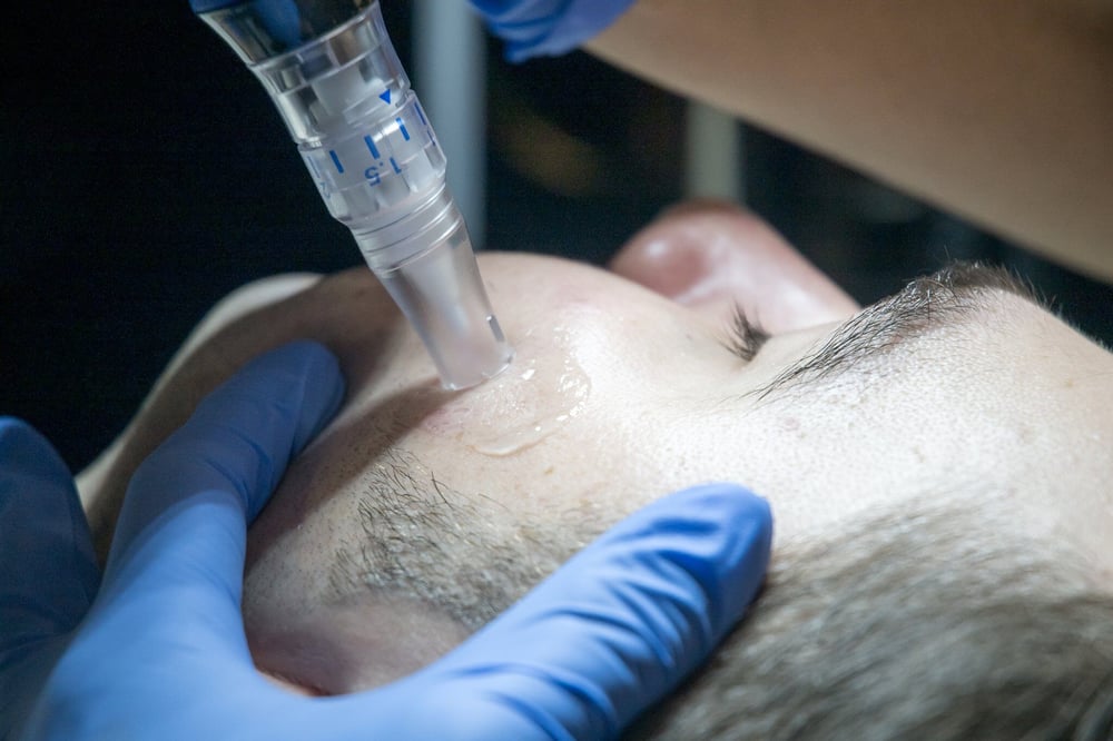 skinpen microneedling treatment