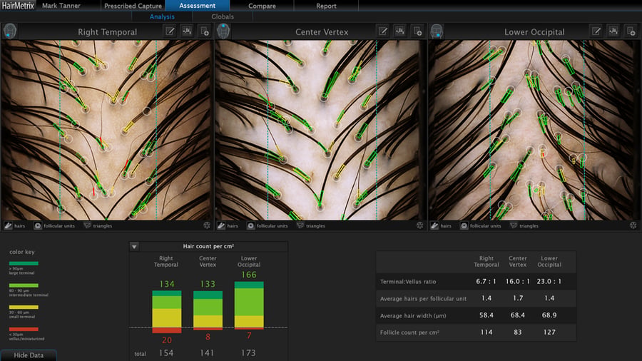 HairMetrix hair and scalp analysis during a Flycatcher hair restoration consultation