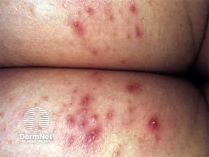 folliculitis1-buttocks-dermnet