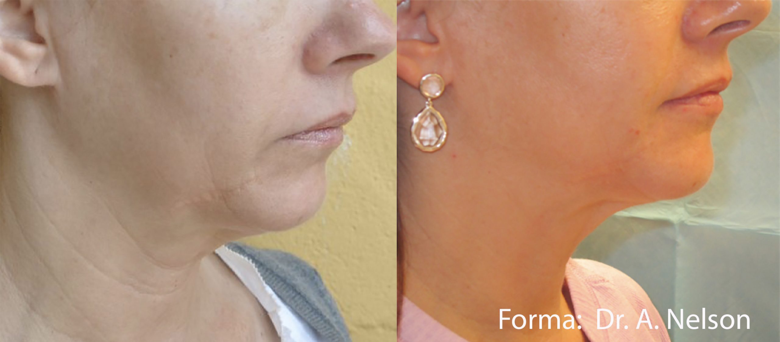 before and after forma treatment for neck tightening