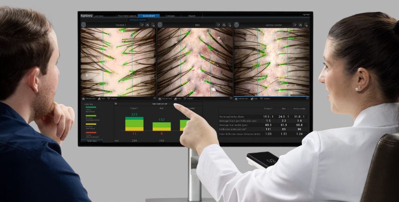 HairMetrix scalp and hair analysis during a Flycatcher hair restoration consultation in Austin