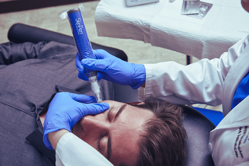 Microneedling treatment with SkinPen device for a man's acne scarring