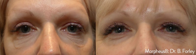 before and after under eye treatment with Morpheus8