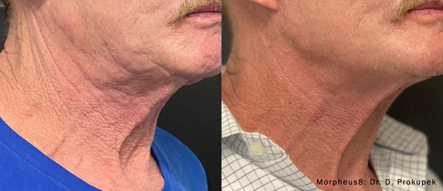 Morpheus8 treatment results on a man's neck