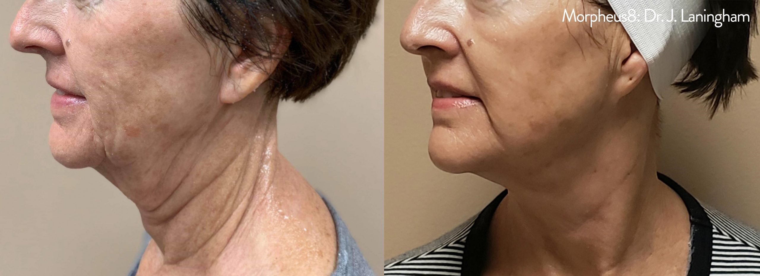 Morpheus8 treating turkey neck before and after