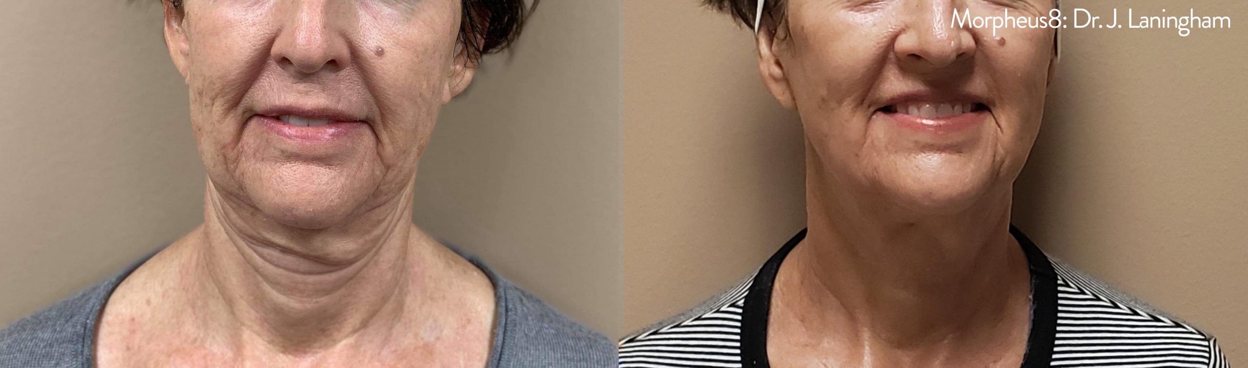 Morpheus8 treating turkey neck before and after