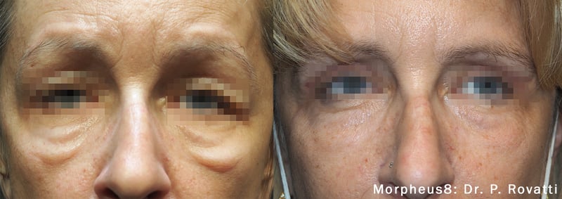 before and after under eye treatment with Morpheus8