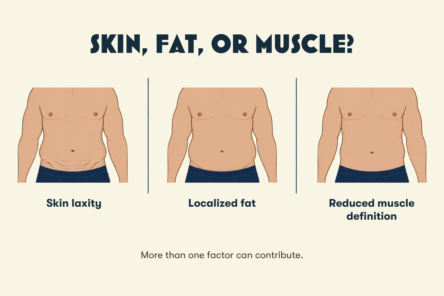 Illustration comparing skin laxity, localized abdominal fat, and reduced muscle definition in men.