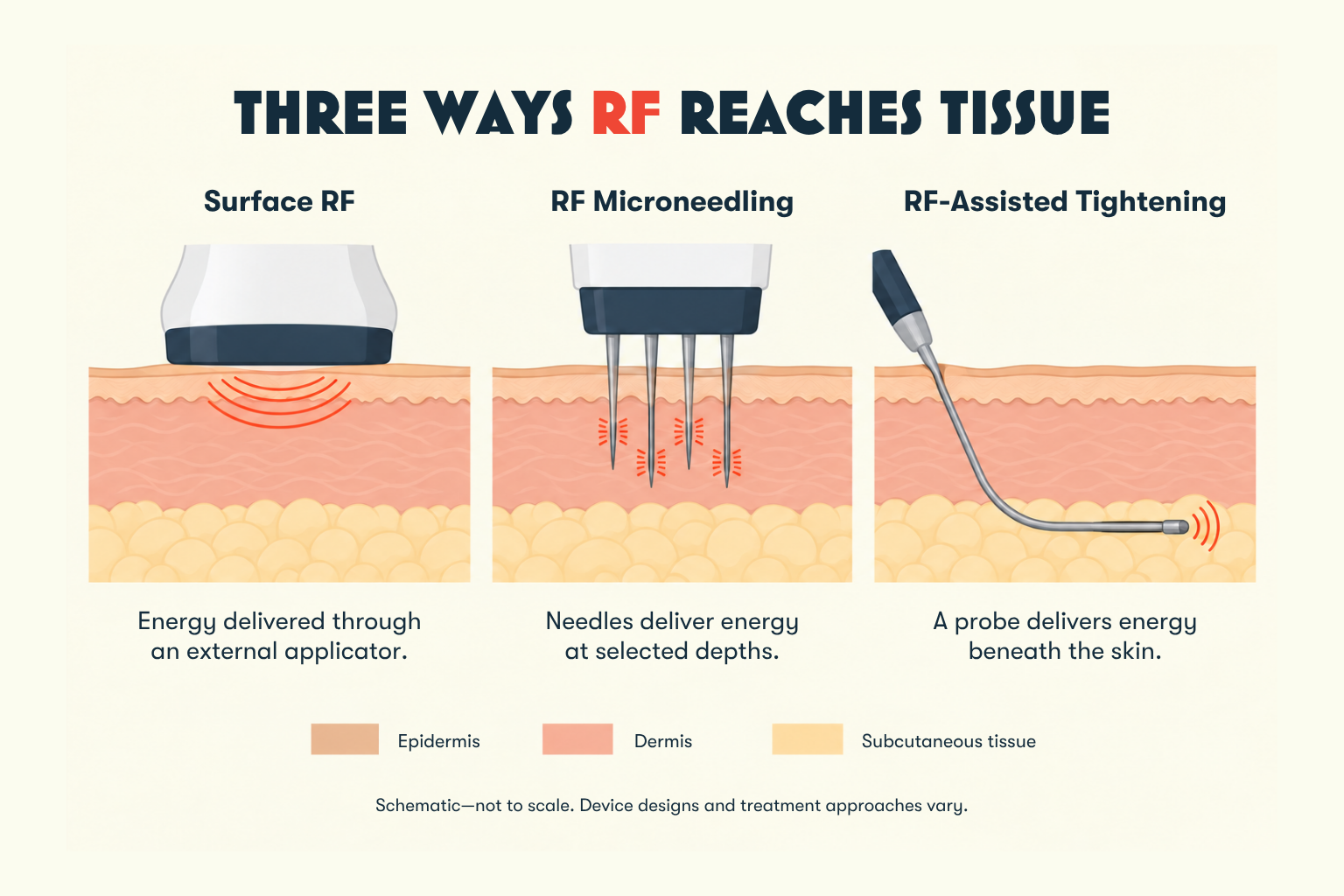 Diagram comparing RF delivery through an external applicator, microneedles within the skin, and a probe beneath the skin.