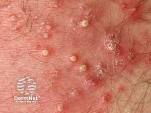 superficial bacterial folliculitis on man's buttocks