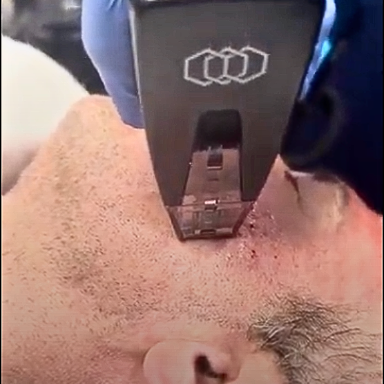 treating scars on man's face with Morpheus8 rf microneedling